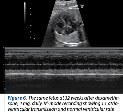 Figure 6. The same fetus at 32 weeks after dexa­metha­sone, 4 mg, daily. M-mode recording showing 1:1 atrio­ven­tricular transmission and normal ventricular rate