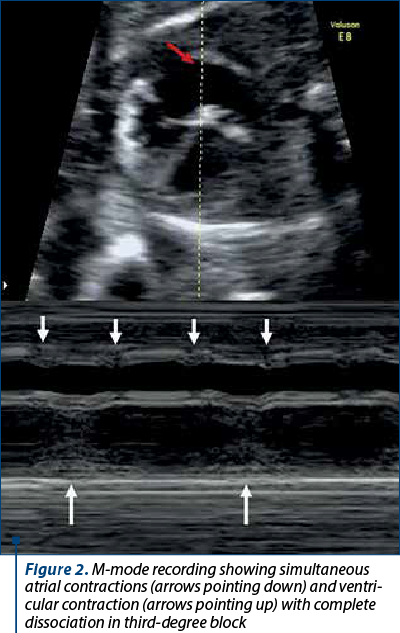 Figure 2. M-mode recording showing simultaneous atrial contrac­tions (arrows pointing down) and ven­tri­cu­lar contraction (arrows pointing up) with complete dissociation in third-degree block