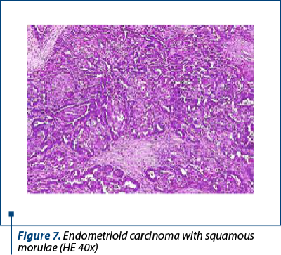 Figure 7. Endometrioid carcinoma with squamous morulae (HE 40x)