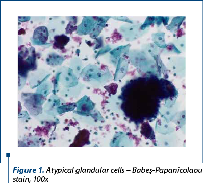 Figure 1. Atypical glandular cells – Babeş-Papanicolaou stain, 100x