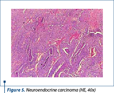 Figure 5. Neuroendocrine carcinoma (HE, 40x)