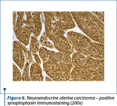 Figure 8. Neuroendocrine uterine carcinoma – positive synaptophysin immunostaining (200x) 