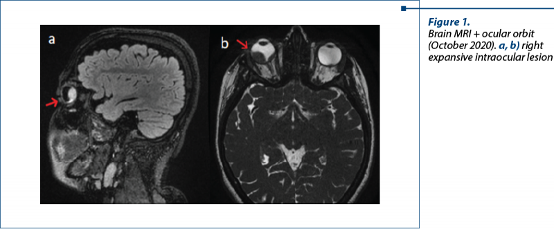 Figure 1.  Brain MRI + ocular orbit (October 2020). a, b) right expansive intraocular lesion