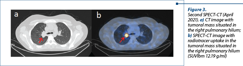 Figure 3.  Second SPECT-CT (April 2021). a) CT image with tumoral mass situated in the right pulmonary hilum; b) SPECT-CT image with radiotracer uptake in the tumoral mass situated in the right pulmonary hilum (SUVlbm 12.19 g/ml)