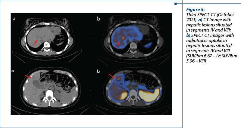 Figure 5.  Third SPECT-CT (October 2021). a) CT image with hepatic lesions situated in segments IV and VIII; b) SPECT CT images with radiotracer uptake in hepatic lesions situated in segments IV and VIII (SUVlbm 6.67 – IV; SUVlbm 5.06 – VIII)