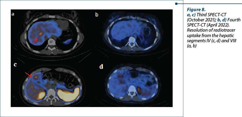 Figure 8.  a, c) Third SPECT-CT (October 2021); b, d) Fourth SPECT-CT (April 2022). Resolution of radiotracer uptake from the hepatic segments IV (c, d) and VIII (a, b)