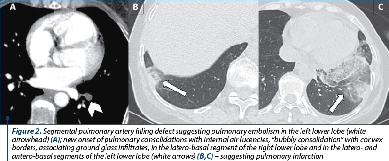 Figure 2. Segmental pulmonary artery filling defect suggesting pulmonary embolism in the left lower lobe (white arrow­head) (A); new onset of pulmonary consolidations with internal air lucencies, “bubbly consolidation” with convex borders, as­so­cia­ting ground glass infiltrates, in the latero-basal segment of the right lower lobe and in the latero- and antero-basal segments of the left lower lobe (white arrows) (B,C) – suggesting pulmonary infarction