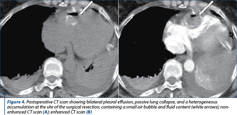 Figure 4. Postoperative CT scan showing bilateral pleural effusion, passive lung collapse, and a heterogeneous accumulation at the site of the surgical resection, containing a small air bubble and fluid content (white arrows); non-enhanced CT scan (A); enhanced CT scan (B)