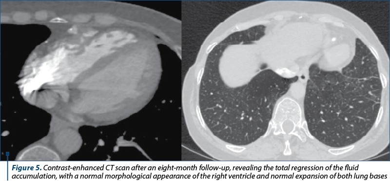 Figure 5. Contrast-enhanced CT scan after an eight-month follow-up, revealing the total regression of the fluid accumulation, with a normal morphological appearance of the right ventricle and normal expansion of both lung bases