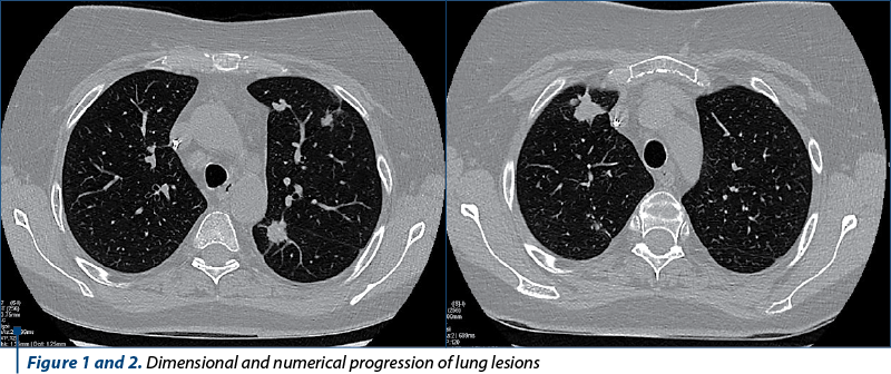 Figure 1 and 2. Dimensional and numerical progression of lung lesions