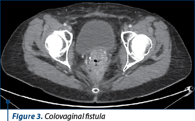 Figure 3. Colovaginal fistula