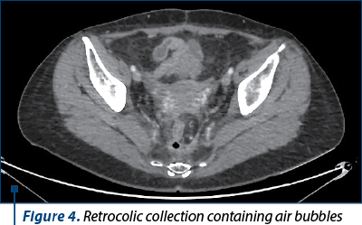 Figure 4. Retrocolic collection containing air bubbles