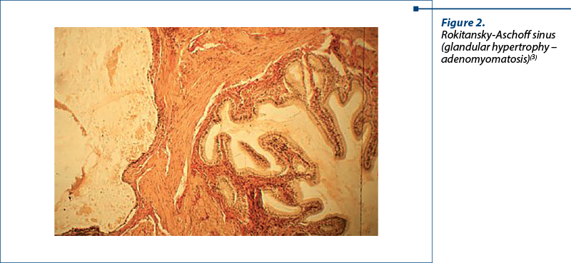 Figure 2.  Rokitansky-Aschoff sinus (glandular hypertrophy – adenomyomatosis)(3)