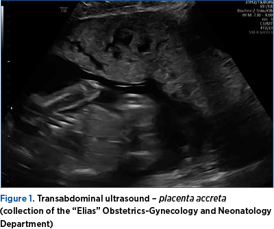 Figure 1. Transabdominal ultrasound – placenta accreta  (collection of the “Elias” Obstetrics-Gynecology and Neonatology Department)