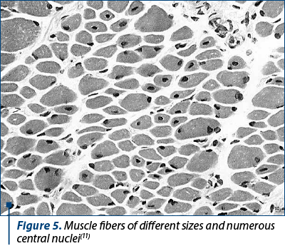 Figure 5. Muscle fibers of different sizes and numerous central nuclei(11)