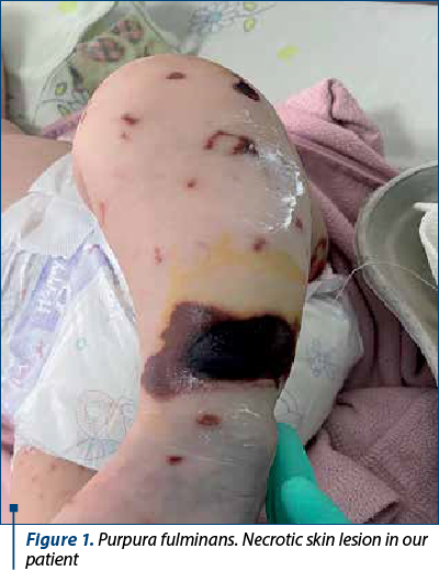 Figure 1. Purpura fulminans. Necrotic skin lesion in our patient