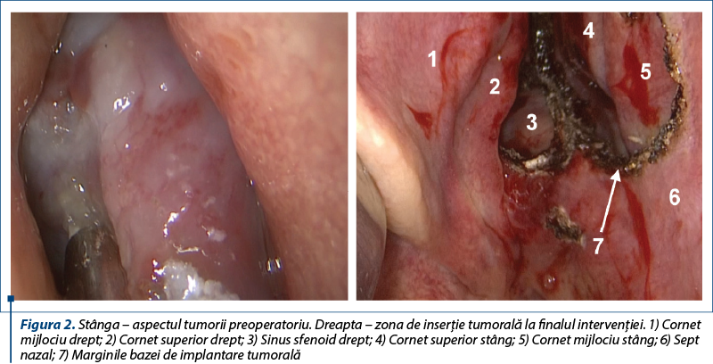 Figura 2. Stânga – aspectul tumorii preoperatoriu. Dreapta – zona de inserţie tumorală la finalul intervenţiei. 1) Cornet mijlociu drept; 2) Cornet superior drept; 3) Sinus sfenoid drept; 4) Cornet superior stâng; 5) Cornet mijlociu stâng; 6) Sept nazal; 7) Marginile bazei de implantare tumorală