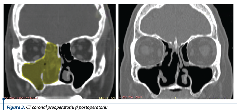 Figura 3. CT coronal preoperatoriu şi postoperatoriu