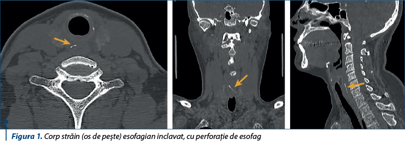 Figura 1. Corp străin (os de peşte) esofagian inclavat, cu perforaţie de esofag