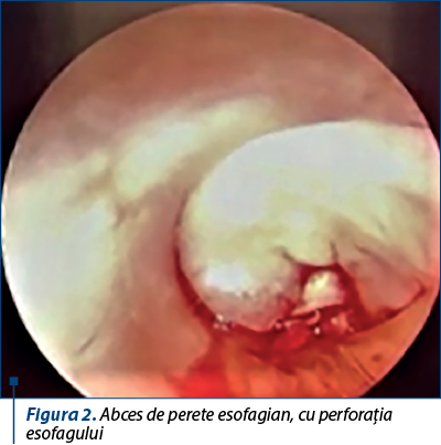 Figura 2. Abces de perete esofagian, cu perforaţia esofagului