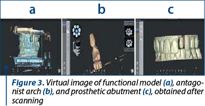 Figure 3. Virtual image of functional model (a), anta­go­nist arch (b), and prosthetic abutment (c), obtained after scanning