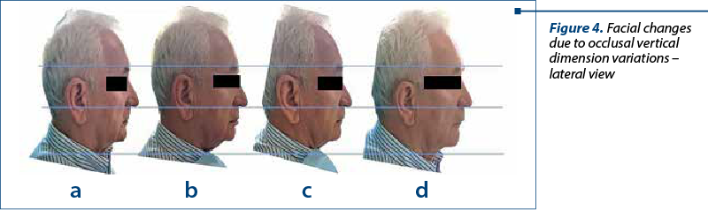 Figure 4. Facial changes due to occlusal vertical dimension variations – lateral view
