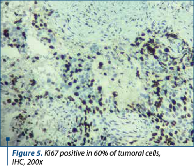 Figure 5. Ki67 positive in 60% of tumoral cells,  IHC, 200x