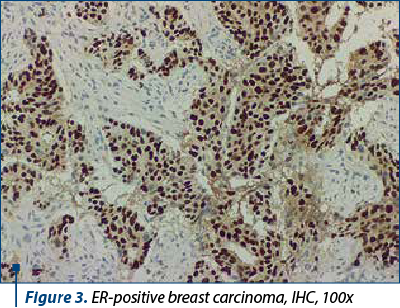 Figure 3. ER-positive breast carcinoma, IHC, 100x