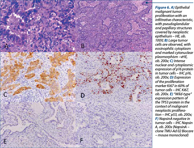 Figure 6. A) Epithelial malignant tumor pro­­li­­fe­ra­tion with an in­fil­tra­tive cha­rac­te­ris­tic, with pseu­do­glan­du­lar and pa­pil­lary struc­tures co­vered by neoplastic epi­the­lium – HE, ob. 100X; B) Large tumor cells are observed, with eo­si­no­philic cy­to­plasm and marked cyto­nu­clear pleo­mor­phism –vHE, ob. 200x; C) In­tense nuclear and cy­to­plas­mic expression of p16 pro­tein in tumor cells – IHC p16, ob. 200x; D) Expression of the proliferation mar­ker Ki67 in 60% of tu­mor cells – IHC Ki67, ob. 200x. E) “Wild-type” expression pattern of the TP53 pro­tein in the context of ma­lig­nant neoplastic pro­li­fe­ra­tion – IHC p53, ob. 200x; F) NapsinA negative in tumor cells – IHC Napsin A, ob. 200x (NapsinA – clone TMU-Ad 02 Biocare – mouse monoclonal)