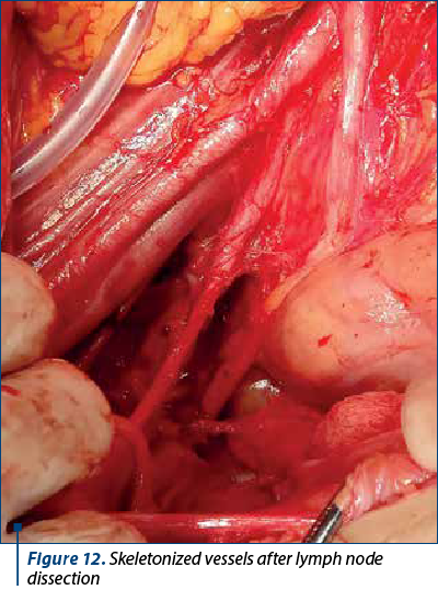 Figure 12. Skeletonized vessels after lymph node dissection