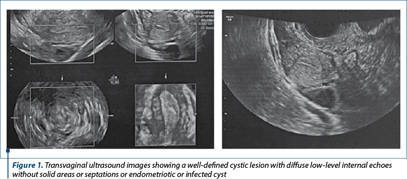 Figure 1. Transvaginal ultrasound images showing a well-defined cystic lesion with diffuse low-level internal echoes without solid areas or septations or endometriotic or infected cyst