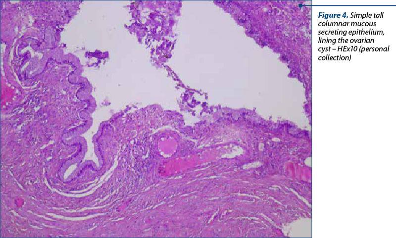 Figure 4. Simple tall columnar mucous secreting epithelium, lining the ovarian cyst – HEx10 (personal collection)