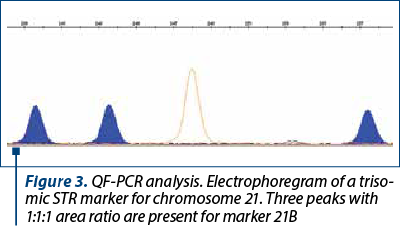Figure 3. QF-PCR analysis. Electrophoregram of a triso­mic STR marker for chromosome 21. Three peaks with 1:1:1 area ratio are present for marker 21B