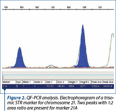Figure 2. QF-PCR analysis. Electrophoregram of a tri­so­mic STR marker for chromosome 21. Two peaks with 1:2 area ratio are present for marker 21A