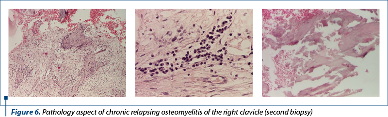 Figure 6. Pathology aspect of chronic relapsing osteomyelitis of the right clavicle (second biopsy)