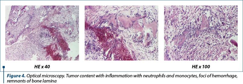 Figure 4. Optical microscopy. Tumor content with inflammation with neutrophils and monocytes, foci of hemorrhage, remnants of bone lamina
