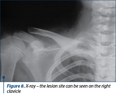 Figure 8. X-ray – the lesion site can be seen on the right clavicle