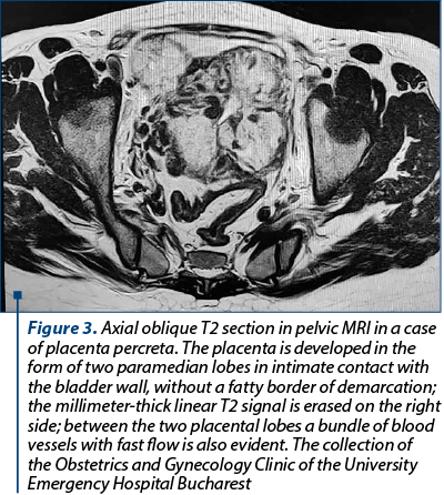 Figure 3. Axial oblique T2 section in pelvic MRI in a case of placenta percreta. The placenta is developed in the form of two paramedian lobes in intimate contact with the bladder wall, without a fatty border of demarcation; the millimeter-thick linear T2 signal is erased on the right side; between the two placental lobes a bundle of blood vessels with fast flow is also evident. The collection of the Obstetrics and Gynecology Clinic of the University Emergency Hospital Bucharest