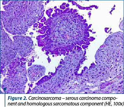 Figure 2. Carcinosarcoma – serous carcinoma com­po­nent and homologous sarcomatous component (HE, 100x)