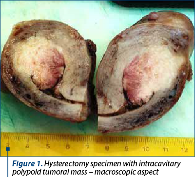 Figure 1. Hysterectomy specimen with intracavitary polypoid tumoral mass – macroscopic aspect