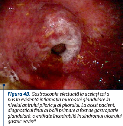 Figura 4B. Gastroscopia efectuată la acelaşi cal a pus în evidenţă inflamaţia mucoasei glandulare la nivelul antrului piloric şi al pilorului. La acest pacient, diagnosticul final al bolii primare a fost de gastropatie glandulară, o entitate încadrabilă în sindromul ulcerului gastric ecvin(6)