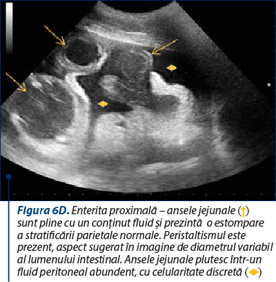 Figura 6D. Enterita proximală – ansele jejunale (↑) sunt pline cu un conţinut fluid şi prezintă  o estompare a stratificării parietale normale. Peristaltismul este prezent, aspect sugerat în imagine de diametrul variabil al lumenului intestinal. Ansele jejunale plutesc într-un fluid peritoneal abundent, cu celularitate discretă (♦)