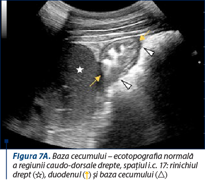 Figura 7A. Baza cecumului – ecotopografia normală a regiunii caudo-dorsale drepte, spaţiul i.c. 17: rinichiul drept (☆), duodenul (↑) şi baza cecumului (△)