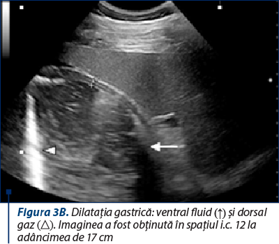 Figura 3B. Dilataţia gastrică: ventral fluid (↑) şi dorsal gaz (△). Imaginea a fost obţinută în spaţiul i.c. 12 la adâncimea de 17 cm