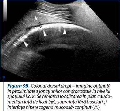 Figura 9B. Colonul dorsal drept – imagine obţinută în proximitatea joncţiunilor condrocostale la nivelul spaţiului i.c. 8. Se remarcă localizarea în plan caudo-median faţă de ficat (☆), suprafaţa fără boseluri şi interfaţa hiperecogenă mucoasă-conţinut (△)