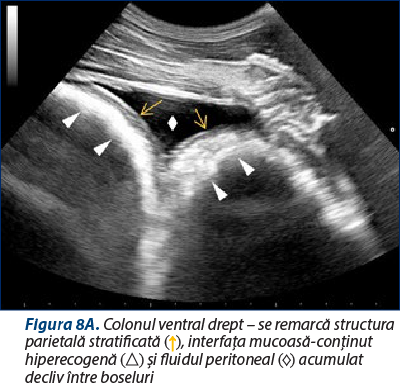 Figura 8A. Colonul ventral drept – se remarcă structura parietală stratificată (↑), interfaţa mucoasă-conţinut hiperecogenă (△) şi fluidul peritoneal (◇) acumulat decliv între boseluri