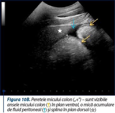 Figura 10B. Peretele micului colon („+”) – sunt vizibile ansele micului colon (↑) în plan ventral, o mică acumulare de fluid peritoneal (↑) şi splina în plan dorsal (☆)