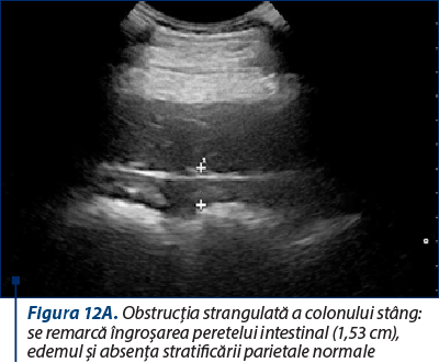 Figura 12A. Obstrucţia strangulată a colonului stâng: se remarcă îngroşarea peretelui intestinal (1,53 cm), edemul şi absenţa stratificării parietale normale