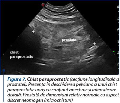Figura 7. Chist paraprostatic (secţiune longitudinală a prostatei). Prezenţa în deschiderea pelviană a unui chist paraprostatic uriaş cu conţinut anechoic şi intensificare distală. Prostată de dimensiuni relativ normale cu aspect discret neomogen (microchisturi)
