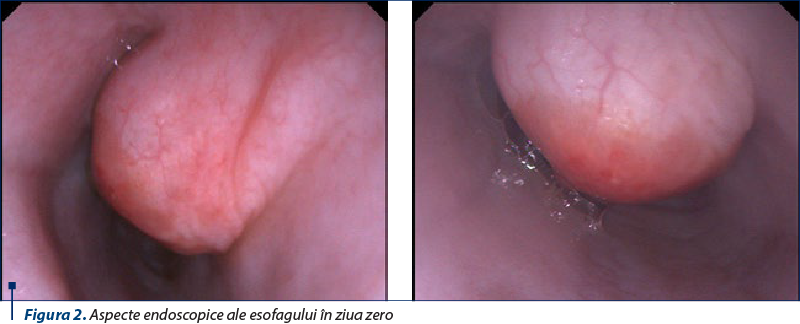 Figura 2. Aspecte endoscopice ale esofagului în ziua zero 